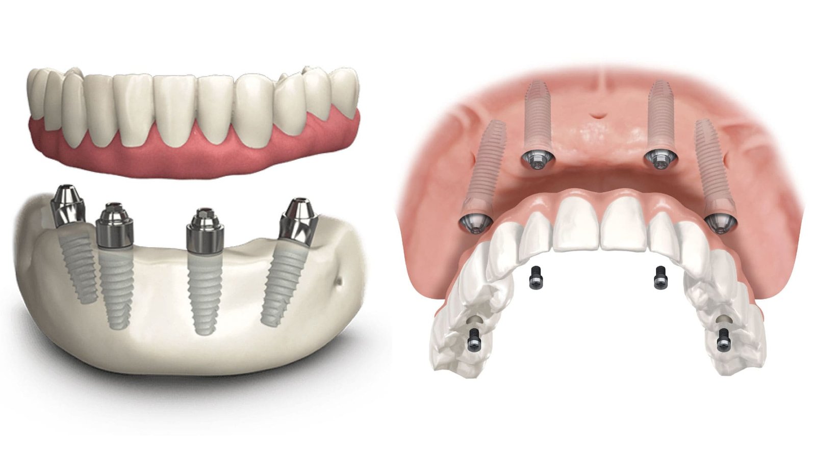 Image of All On 4 All Of 6 ( Same Day Teeth )