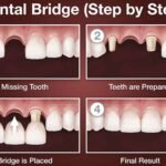 What is a Dental Bridge? Everything You Need to Know