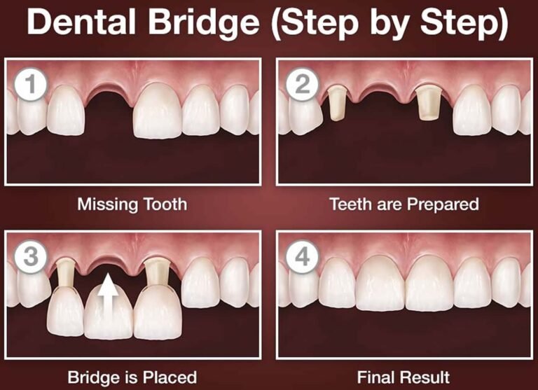What is a Dental Bridge? Everything You Need to Know