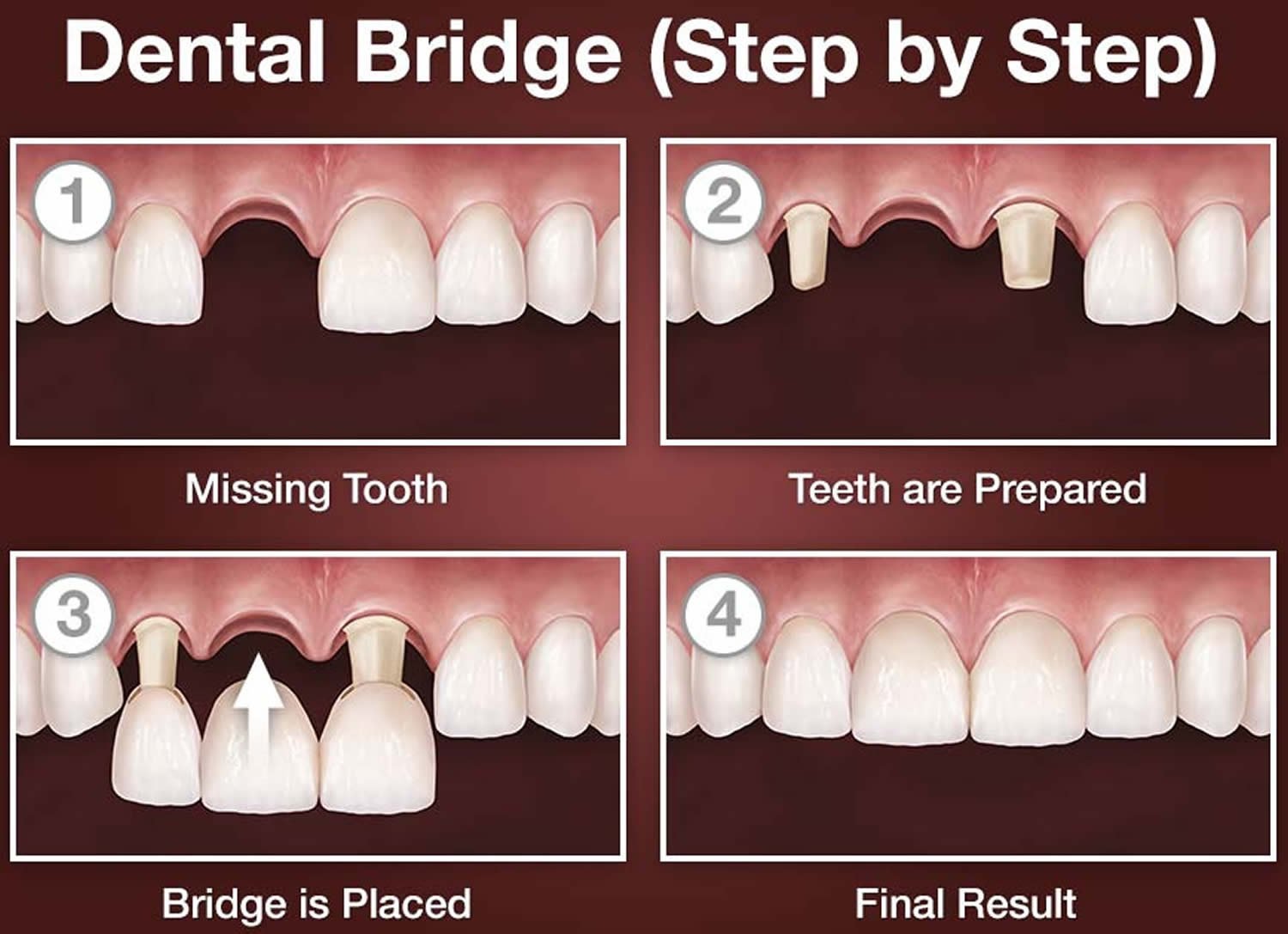 What is a Dental Bridge? Everything You Need to Know
