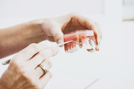 How Much Do Dental Implants Cost in the UK? A Complete Guide