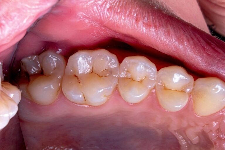 Dental plaque is that sticky, colorless film that forms on your teeth throughout the day. If you don't remove it, it can lead to cavities, gum disease, and even bad breath. The good news? You can dissolve plaque easily by sticking to a good oral hygiene routine and making some smart lifestyle choices. In this article, we’ll dive into how you can get rid of plaque and keep your smile shining bright. What Exactly Is Dental Plaque? Plaque is a thin layer of bacteria that forms on your teeth when the bacteria mix with the sugars and starches in your food. It starts out as a soft, sticky film but, if left untreated, can harden into tartar (also called calculus), which can only be removed by a dentist. When plaque is left on your teeth for too long, it can cause problems like: Cavities (tooth decay) Gum disease (gingivitis or periodontitis) Bad breath Staining of your teeth That’s why it’s so important to regularly remove plaque and prevent it from building up. 1. Brush Your Teeth Properly The most effective way to get rid of plaque is by brushing your teeth the right way. Here are some tips to make sure you’re doing it correctly: Brush for Two Minutes: Spend at least two minutes brushing your teeth, twice a day. Break it into four quadrants and give each area about 30 seconds of attention. Use the Right Toothbrush: Opt for a toothbrush with soft bristles to avoid irritating your gums. If you’re up for it, an electric toothbrush can do a great job at removing plaque, too. Choose Fluoride Toothpaste: Fluoride toothpaste helps protect your enamel and fight off plaque buildup. It’s your best bet for fighting cavities and getting your teeth sparkling clean. Brush All the Surfaces: Make sure you brush not just the front and back of your teeth, but also the chewing surfaces and the areas along your gum line. Plaque loves to hide in these spots. 2. Floss Daily Brushing alone isn’t enough to remove all plaque, especially between your teeth and along the gumline. That’s where flossing comes in. Floss Once a Day: Try to floss once a day, ideally before bedtime. Flossing removes food particles and plaque that your toothbrush can’t reach. Use the Right Technique: Gently slide the floss between your teeth in a sawing motion. Once it’s between your teeth, curve it around each tooth and move it up and down to remove plaque. Consider Alternatives: If traditional floss isn’t your thing, you can use alternatives like dental picks, interdental brushes, or water flossers. They all get the job done, and some people find them easier to use. 3. Use Antibacterial Mouthwash Adding an antibacterial mouthwash to your routine can help fight plaque by killing bacteria in your mouth. Look for Antimicrobial Mouthwash: Mouthwash containing ingredients like chlorhexidine or cetylpyridinium chloride can help reduce plaque and stop bacteria from multiplying in your mouth. Rinse After Brushing and Flossing: For the best results, rinse with mouthwash right after brushing and flossing. This helps eliminate any bacteria or plaque left behind. Avoid Alcohol-Based Mouthwashes: Alcohol can dry out your mouth, and a dry mouth can lead to more plaque buildup. Opt for an alcohol-free mouthwash to keep things fresh and healthy. 4. Eat a Plaque-Fighting Diet What you eat can have a big impact on the amount of plaque that builds up on your teeth. Here’s how to use your diet to your advantage: Limit Sugary Foods: Plaque thrives on sugar, so try to limit foods like candy, soda, and sugary snacks. Eating sugar between meals is particularly bad for your teeth. Choose Plaque-Busting Foods: Certain foods like apples, carrots, and celery help clean your teeth by increasing saliva production. Dairy products like cheese can also help neutralize acids in your mouth. Drink Plenty of Water: Drinking water throughout the day helps wash away food particles and plaque. It also keeps your mouth hydrated, which is important for fighting plaque naturally. 5. Visit the Dentist Regularly Even if you brush and floss like a pro, plaque can still build up in places that are hard to reach. That’s why seeing your dentist regularly is crucial. Get Cleanings Every Six Months: Regular professional cleanings will help remove tartar that has formed from plaque. Your dentist can also check for any early signs of gum disease or other problems that might be related to plaque buildup. Ask About Plaque Prevention: While you’re at your appointment, ask your dentist for any tips on plaque prevention. They might recommend treatments like fluoride treatments or sealants for added protection. 6. Quit Smoking and Manage Stress Both smoking and stress can contribute to plaque buildup, so it’s worth addressing these factors if you want to keep your teeth plaque-free. Quit Smoking: Smoking not only makes your teeth more prone to plaque, but it also reduces saliva production, which is your mouth’s natural defense against plaque. If you smoke, quitting is one of the best things you can do for your oral health. Reduce Stress: Chronic stress can weaken your immune system, making it harder for your body to fight off the bacteria that cause plaque. Try to find ways to manage stress, such as exercising or practicing mindfulness. 7. Use Plaque-Removing Products There are several products specifically designed to help reduce plaque buildup and improve your oral hygiene routine. Plaque-Removing Toothpaste: Look for toothpastes with ingredients like pyrophosphates or zinc citrate, which help break down plaque and prevent it from hardening into tartar. Chewing Gum: Sugar-free chewing gum can help remove plaque and stimulate saliva production, which naturally helps cleanse your mouth after meals. Plaque-Disclosing Tablets: These tablets temporarily stain plaque a bright color, showing you exactly where plaque is building up, so you can target those areas more effectively. Conclusion: Keep That Smile Healthy! Removing plaque is key to preventing cavities, gum disease, and other oral health issues. By brushing and flossing properly, using mouthwash, eating a healthy diet, and getting regular dental check-ups, you can keep plaque at bay and maintain a bright, healthy smile for years to come. Remember, while home care is essential, professional dental cleanings every six months are a must for keeping your teeth and gums in top shape. Quick Tips for a Plaque-Free Smile: Brush and floss twice a day. Use mouthwash to target bacteria. Avoid sugary snacks and drinks. Schedule regular dental visits. With these simple practices, you’ll be well on your way to a cleaner, healthier mouth!
