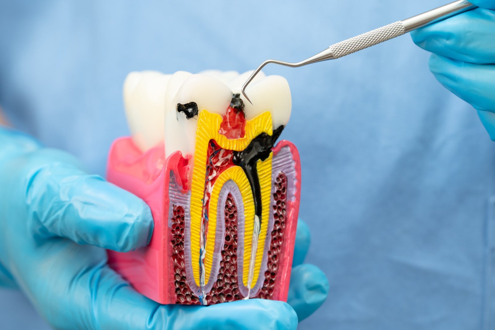 Root Canal Treatment