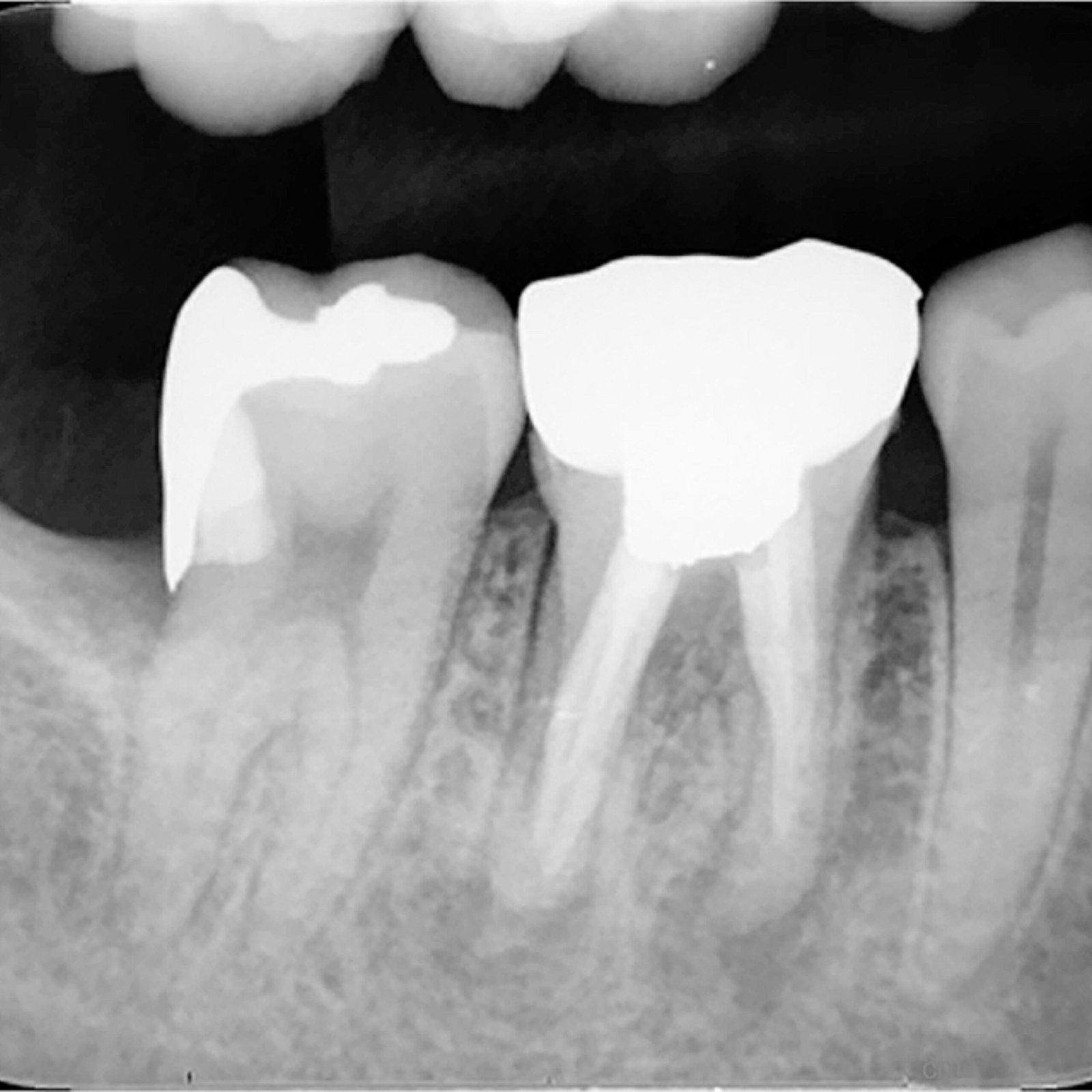 Image of Management of Root Perforation