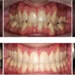 Image of gum recession treatment