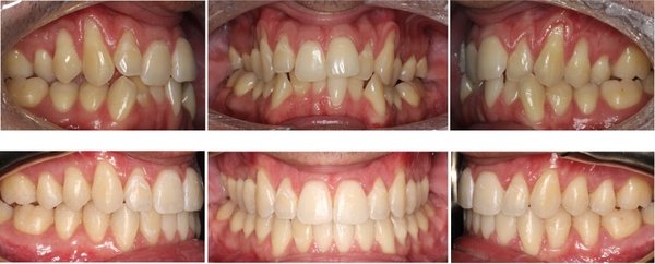 Image of gum recession treatment