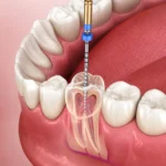 Image of Dental root canal procedure close-up