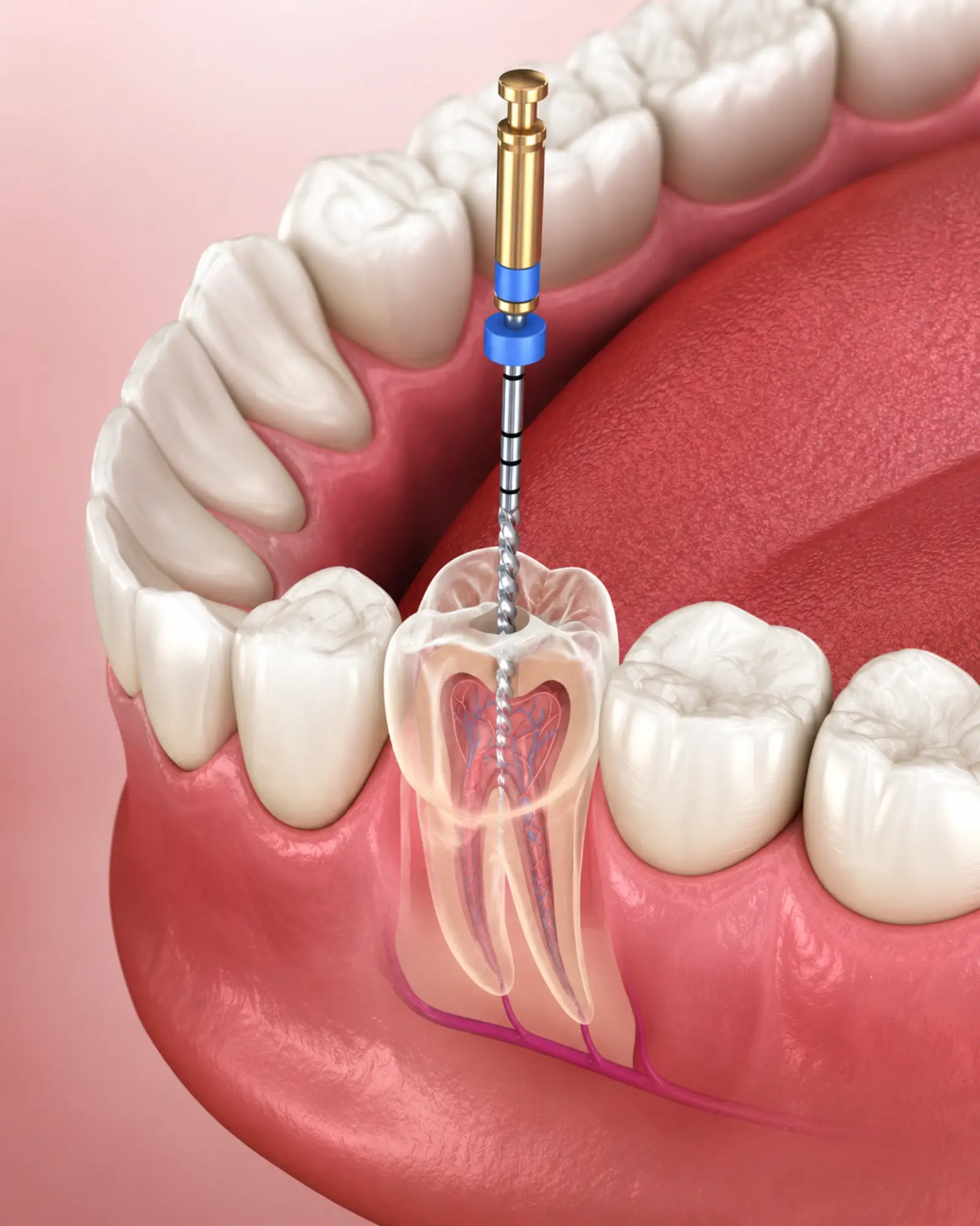 Image of Dental root canal procedure close-up