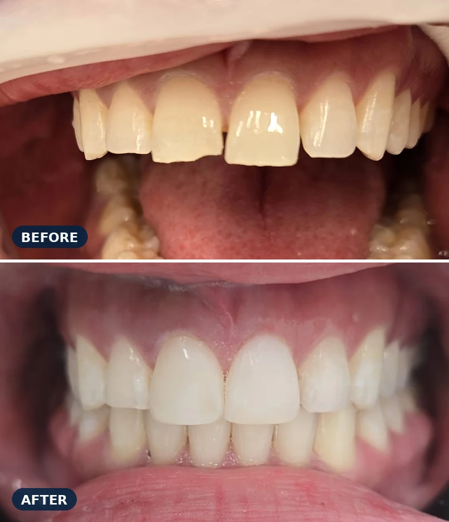 Before and after composite bonding at Ashtead Dental