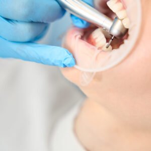 Dental cleaning treatment at Ashtead Dental