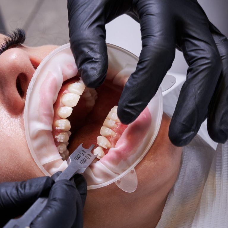 Implant-Secured-Dentures
