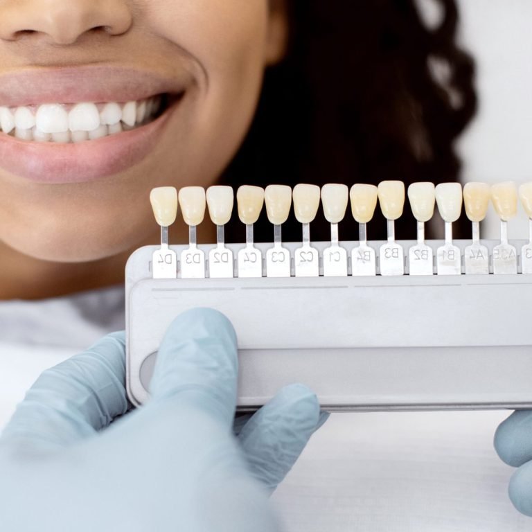 Porcelain-Veneers