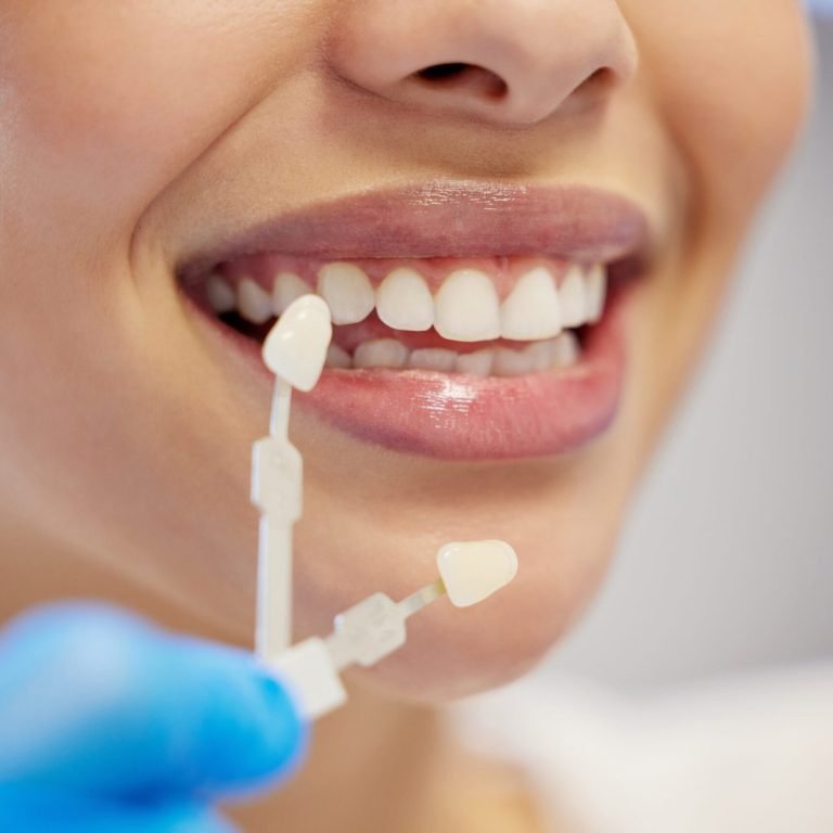 Tooth-Whitening