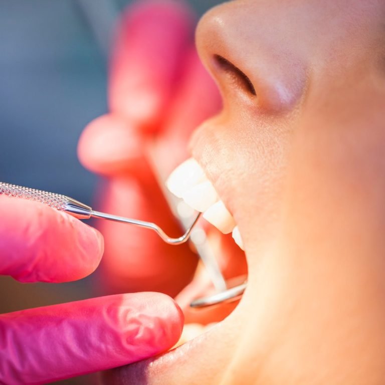 White-Fillings