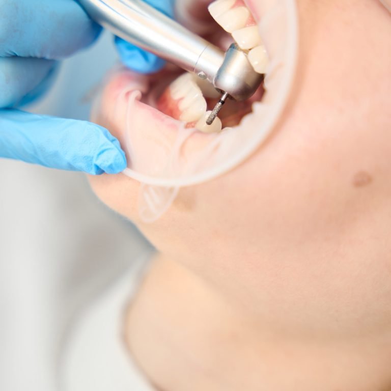 Drill in the hands of a dentist treats a patient's teeth