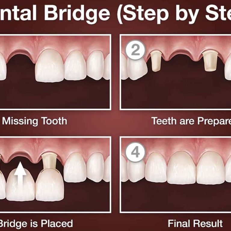 What is a Dental Bridge? Everything You Need to Know