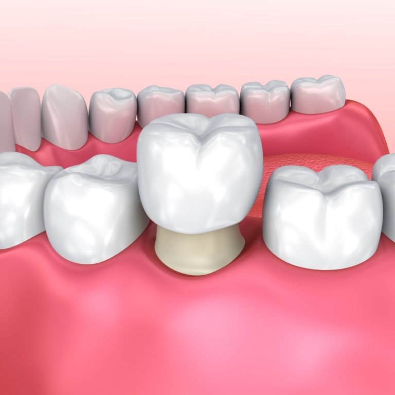 dental crown