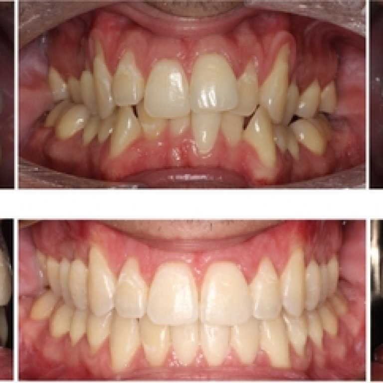 Image of gum recession treatment