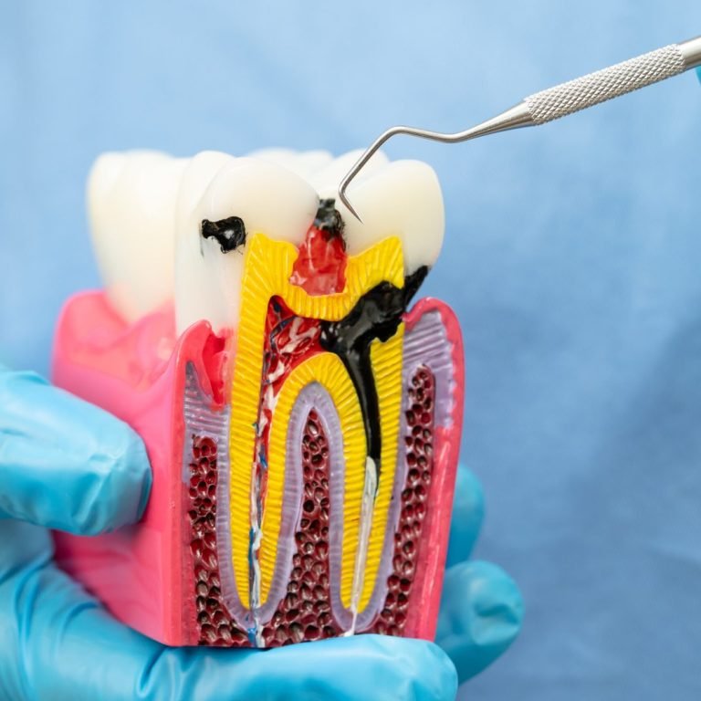 Root Canal Treatment