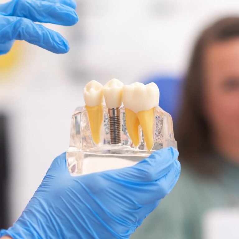 single-tooth-implants